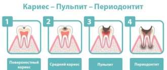 Эффективные методы лечения пульпита и периодонтита