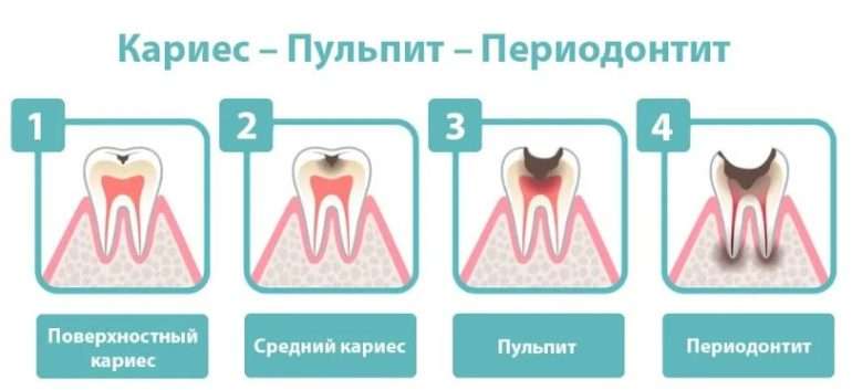 Эффективные методы лечения пульпита и периодонтита