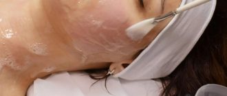 Химический пилинг кожи лица: все о популярной процедуре