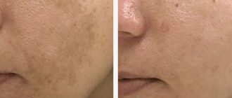 Удаляем пигментацию: почему стоит запланировать сеанс на зимний сезон?