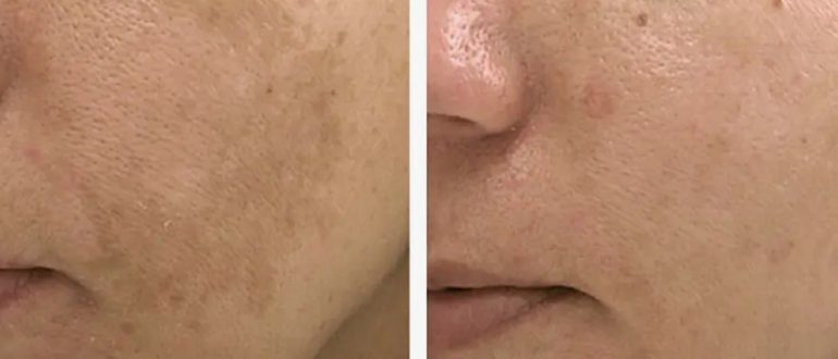 Удаляем пигментацию: почему стоит запланировать сеанс на зимний сезон?